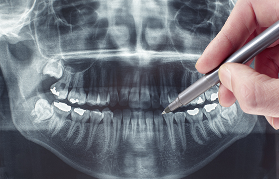 安全性を高める歯科用CT