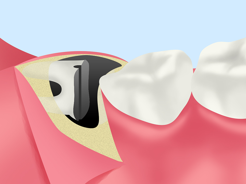 歯の分割・抜歯